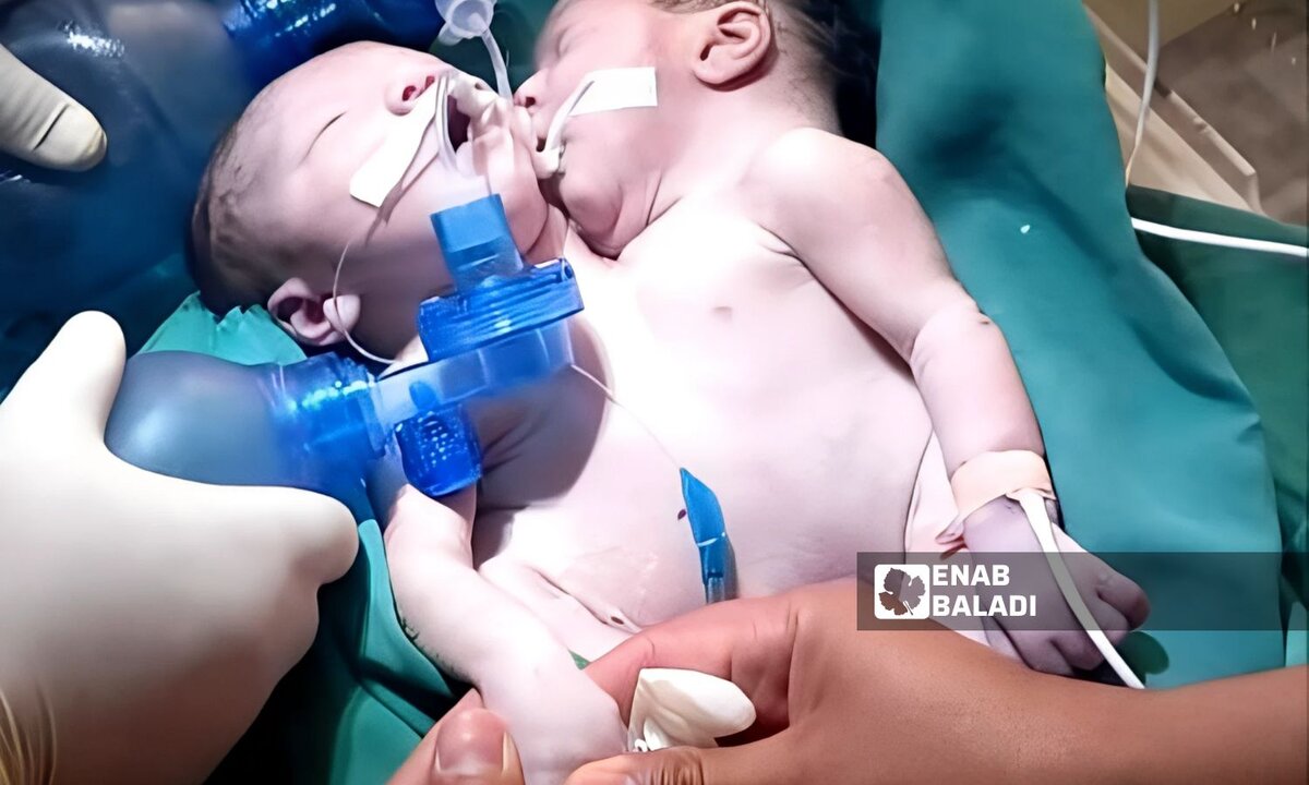 مأساة في رأس العين: ولادة توأم سيامي ملتصق وفقدانهما بعد نقلهما إلى تركيا